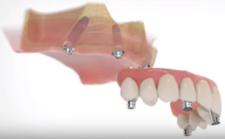 All On Four Dental Implants Long Island NY 9 All on Four Dental Implants