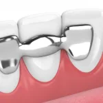 All On Four Dental Implants Long Island NY 10 Dental-Bridges