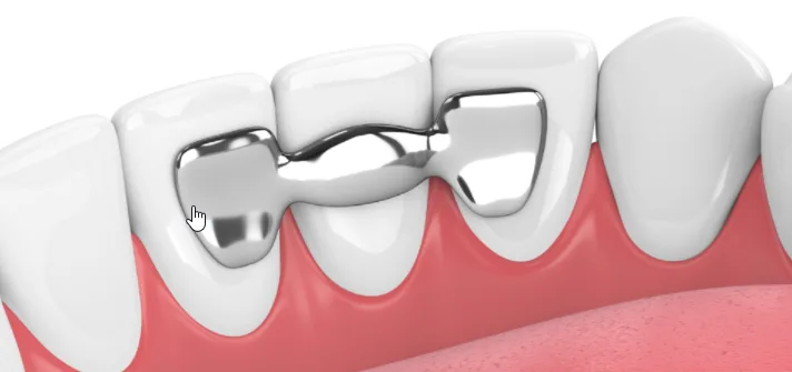 Dental Bridges vs Dental Implants The Shocking Truth: 1 Dental-Bridges