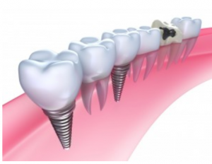 dental bridge vs dental implant image