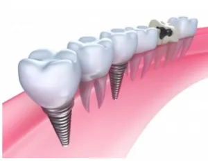 Dental Bridges vs Dental Implants: Which Option is Right for You? 2 dental bridge vs dental implant image